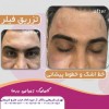 بهترین مرکز لیزر موهای زائد در تهران که با دستگاه