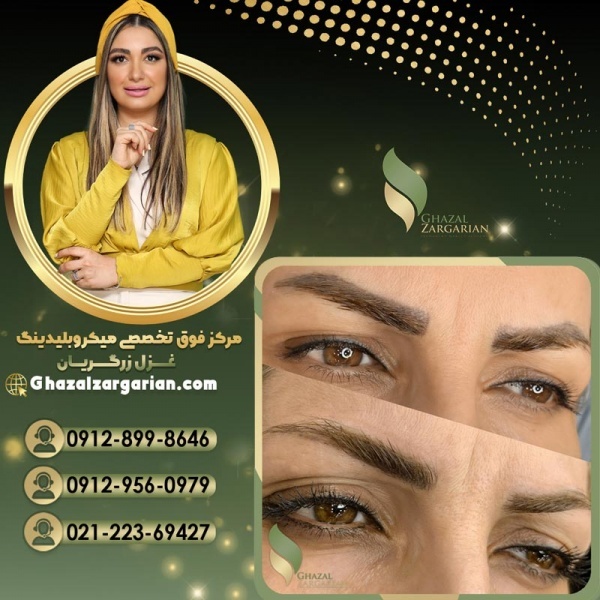 جدیدترین روش فیبروز با بیشترین کیفیت