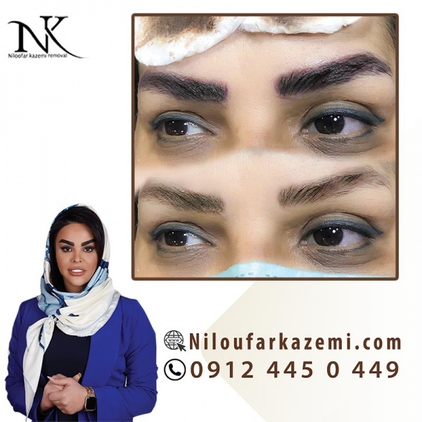 آموزش ریموو تاتو با بروزترین تکنیک کاملا تخصصی