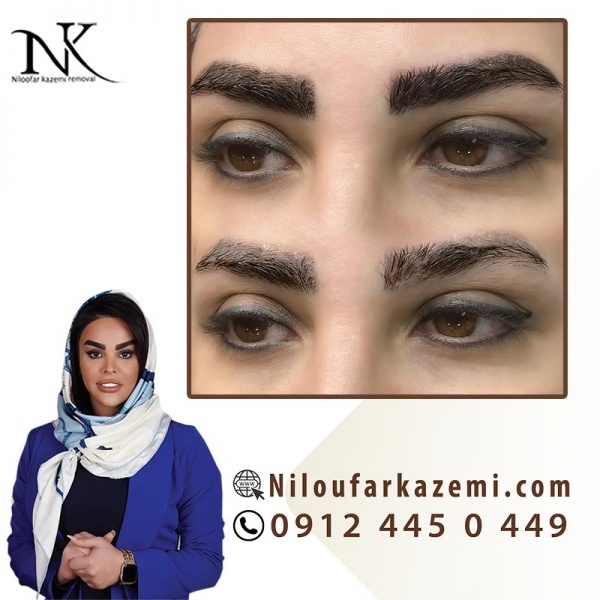 قیمت ریموو تاتو درمرکز تخصصی نیلوفر کاظمی
