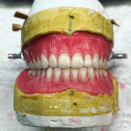 ساخت انواع دندان مصنوعی،ساخت پلاک کروم کبالت براسا