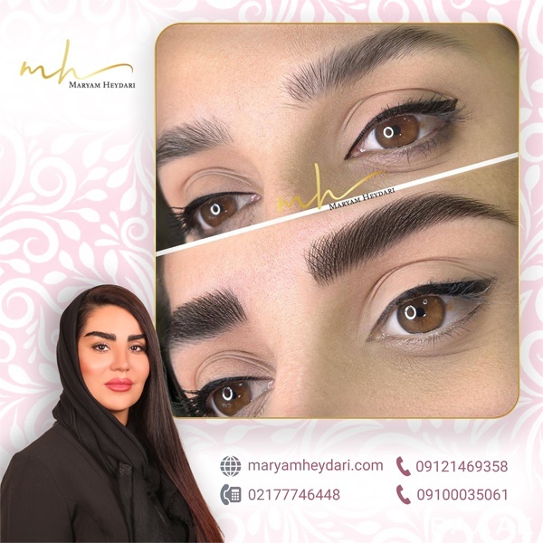 بهترین میکروپیکمنتشن کار در شرق تهران مریم حیدری
