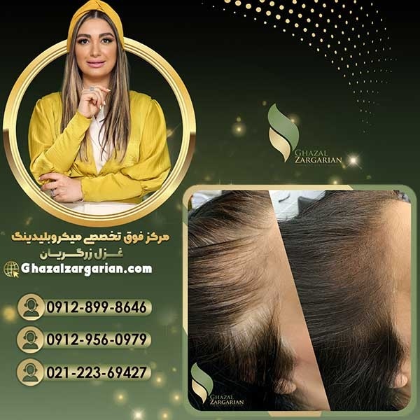 پاک کردن تاتو خط چشم بصورت پیشرفته