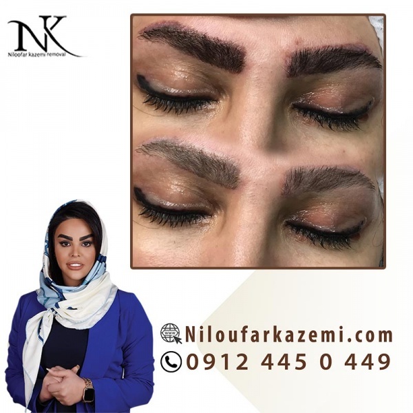 ریموو تاتو بدون درد در یک جلسه