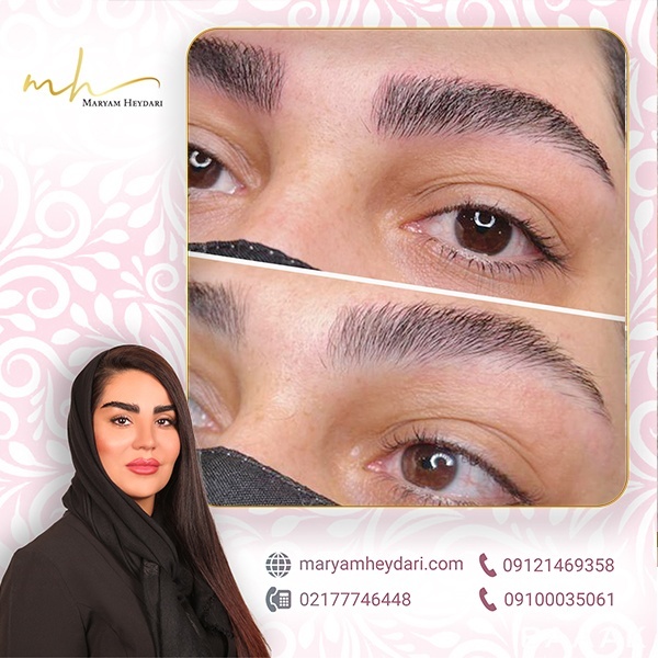 بهترین مرکز فیبروز ابرو در شرق تهران کاملا تخصصی