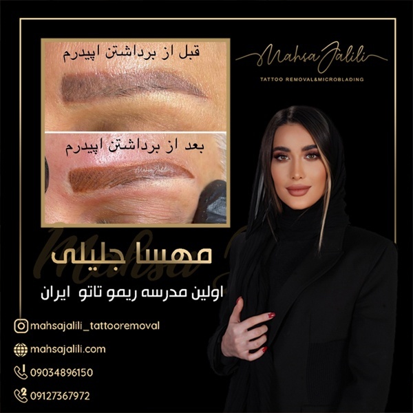 آموزش پاک کردن و ریموو تاتو قدیمی با مواد ریموور